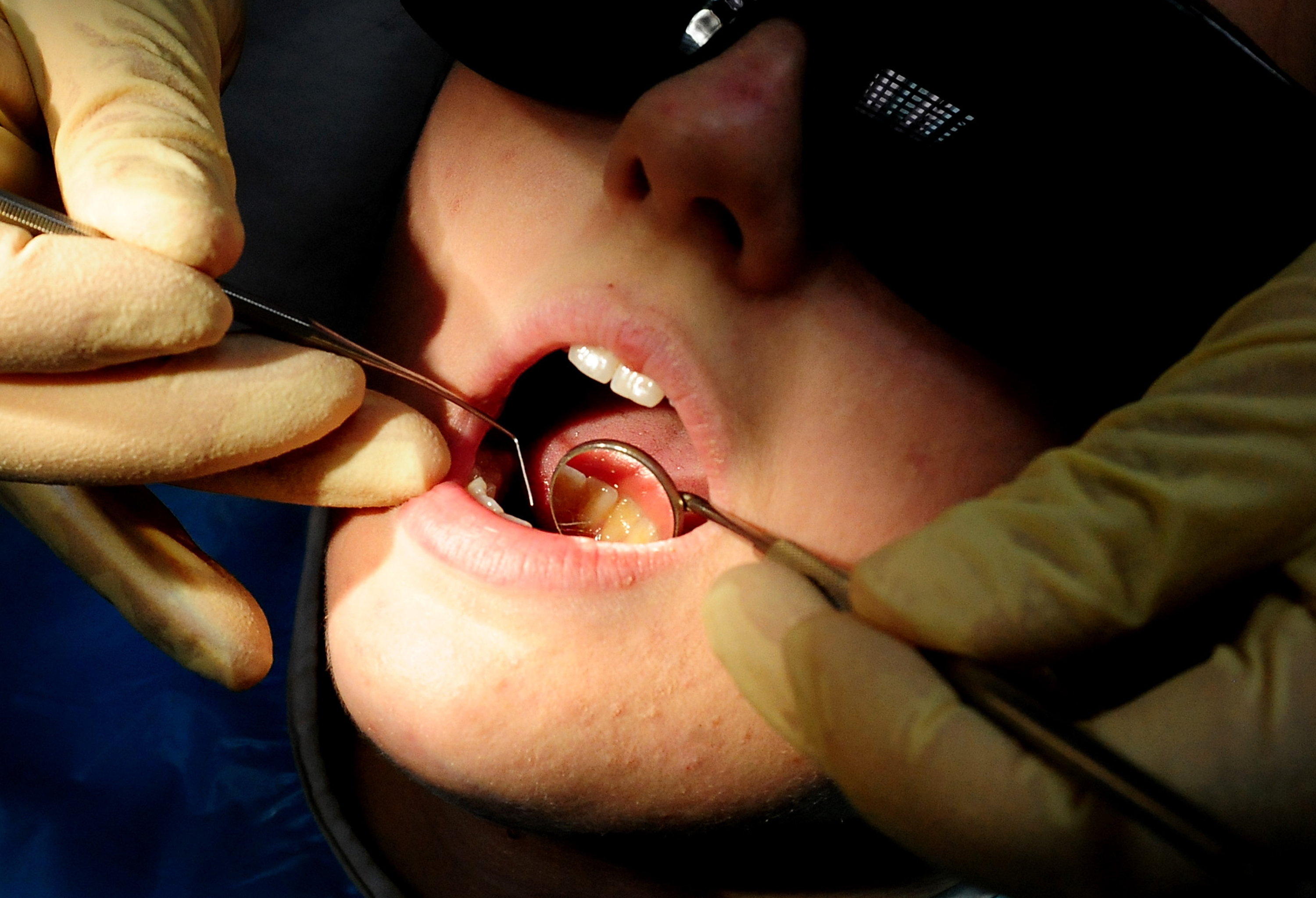 More than 100 hospital admissions in Teignbridge to remove children's rotten teeth