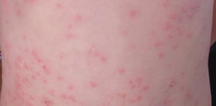 Parents urged to check child vaccinations amid fear of measles surge