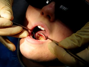 More than a quarter of children have rotting teeth in Teignbridge