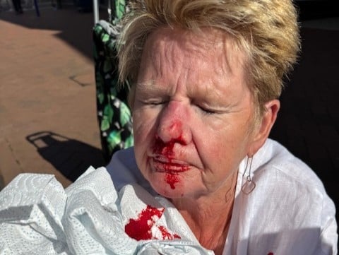 Bruised and bloodied  - Jane Melling after her fall